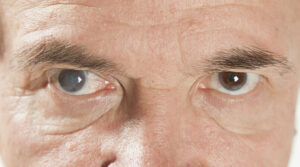 cirurgia de catarata como funciona