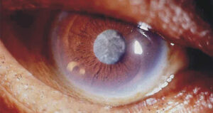 cirurgia de catarata como funciona